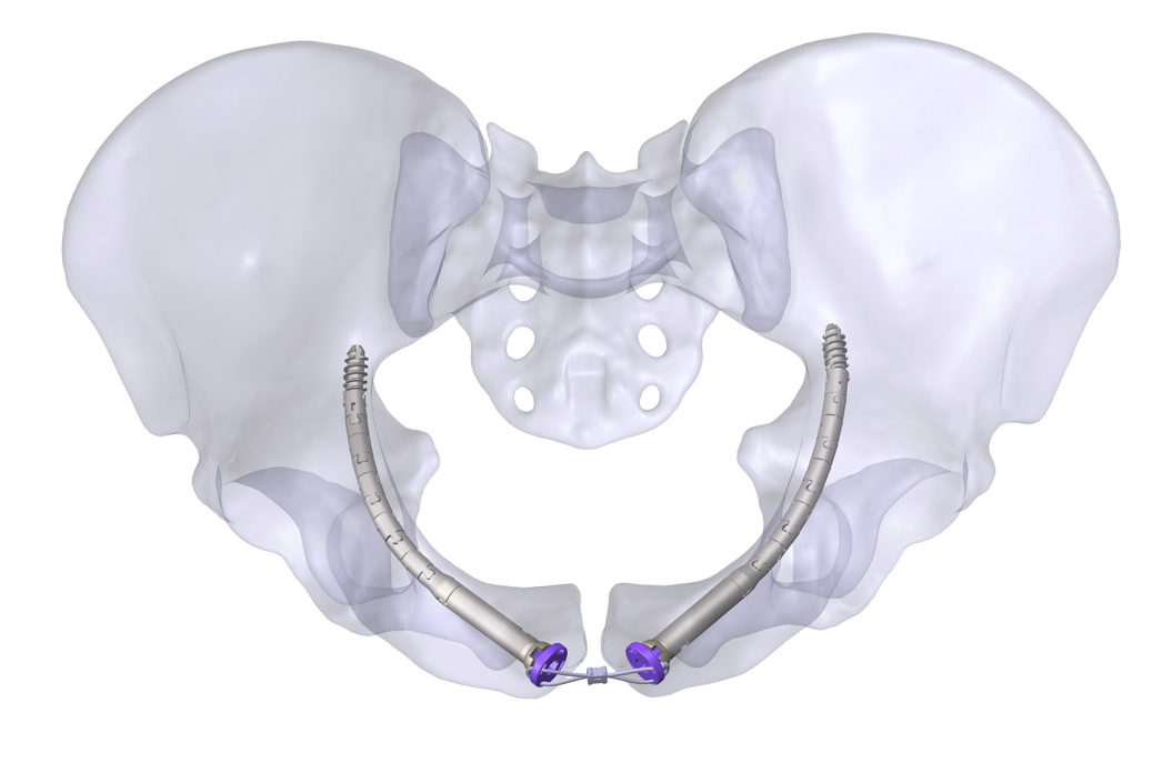 Render of two curved implants joined by a flexible connector at the pubic symphysis